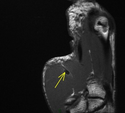Figure 4 for case Flexor pollicis longus tendon ( RID2383 ) laceration